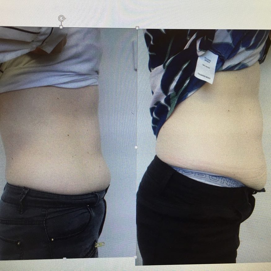 trusculpt before and after